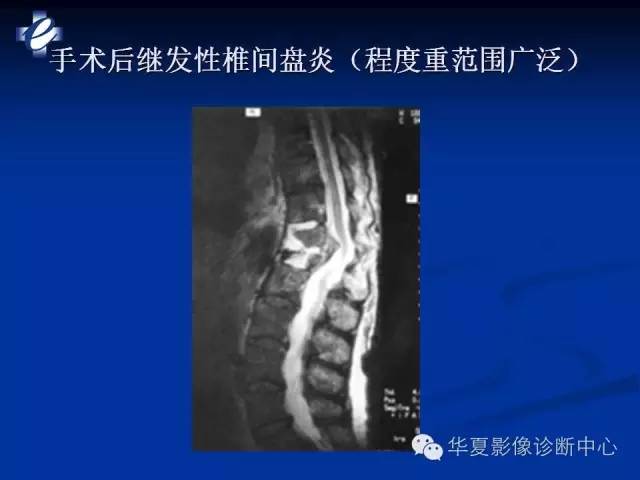 【PPT】骨与关节感染的影像学诊断