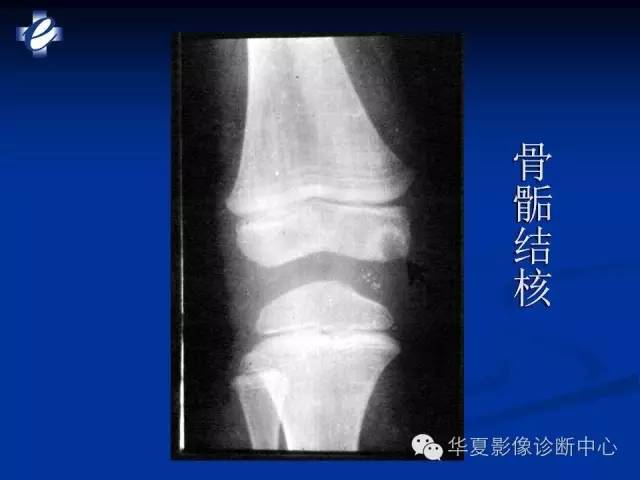 【PPT】骨与关节感染的影像学诊断
