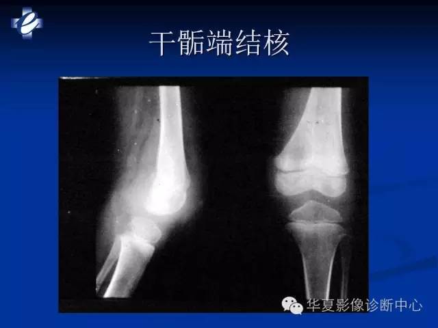 【PPT】骨与关节感染的影像学诊断