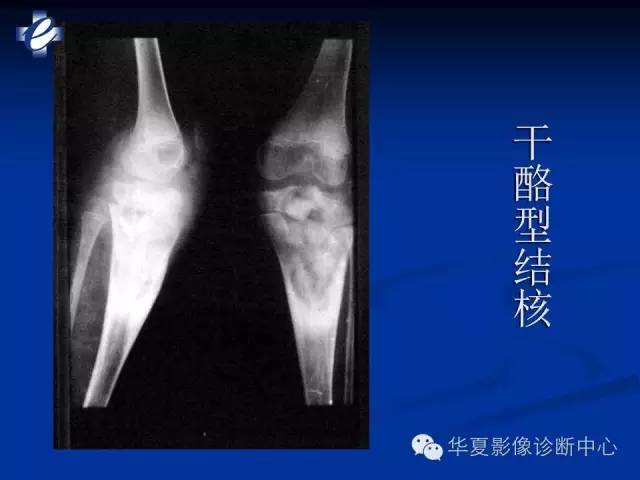 【PPT】骨与关节感染的影像学诊断