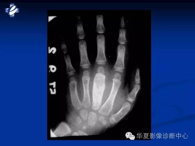 【PPT】骨与关节感染的影像学诊断