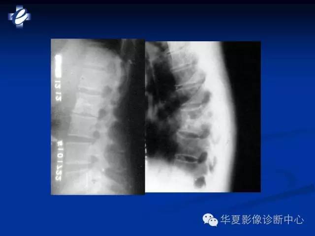 【PPT】骨与关节感染的影像学诊断