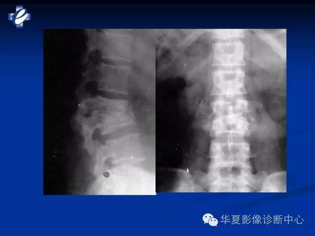 【PPT】骨与关节感染的影像学诊断