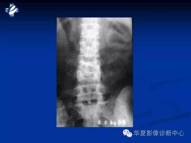 【PPT】骨与关节感染的影像学诊断
