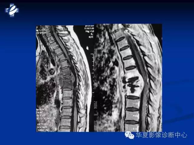 【PPT】骨与关节感染的影像学诊断