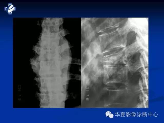 【PPT】骨与关节感染的影像学诊断