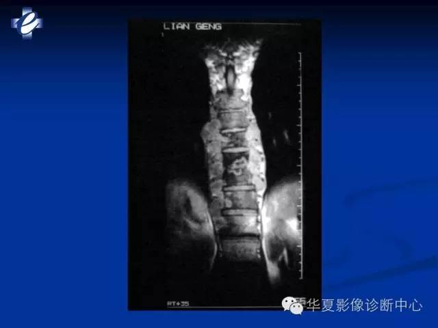 【PPT】骨与关节感染的影像学诊断