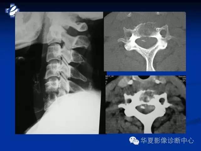 【PPT】骨与关节感染的影像学诊断