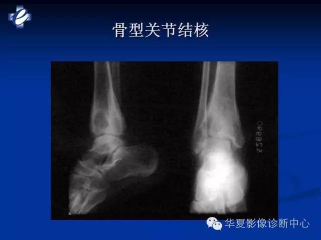 【PPT】骨与关节感染的影像学诊断