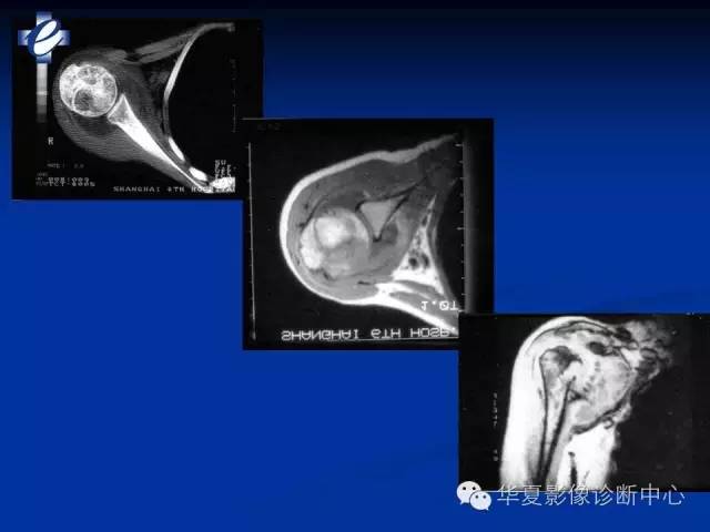 【PPT】骨与关节感染的影像学诊断