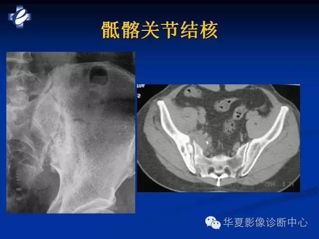 【PPT】骨与关节感染的影像学诊断