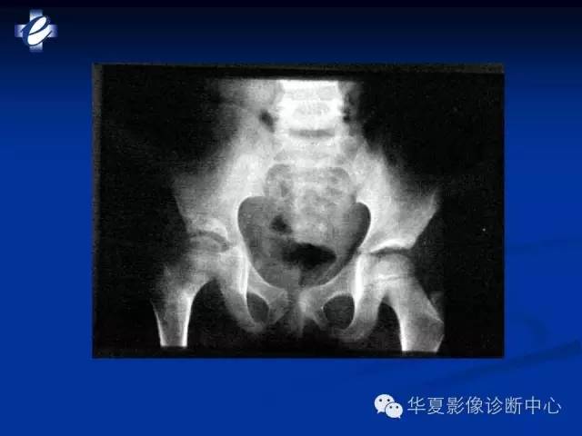 【PPT】骨与关节感染的影像学诊断