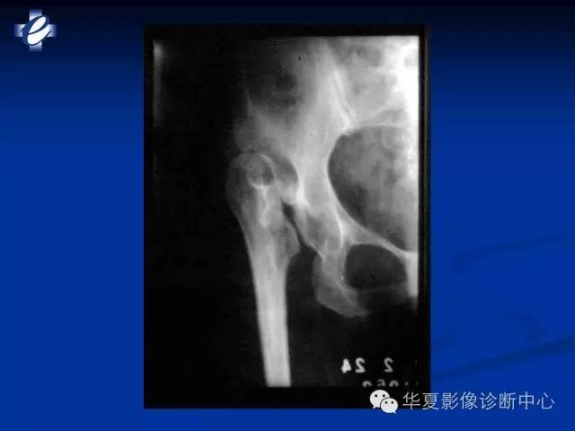 【PPT】骨与关节感染的影像学诊断