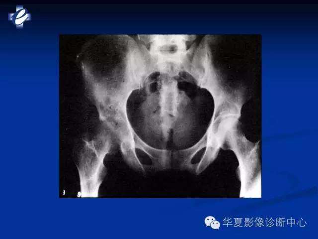 【PPT】骨与关节感染的影像学诊断