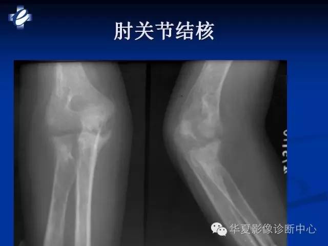 【PPT】骨与关节感染的影像学诊断