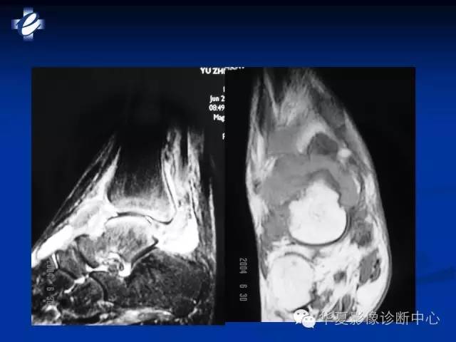 【PPT】骨与关节感染的影像学诊断