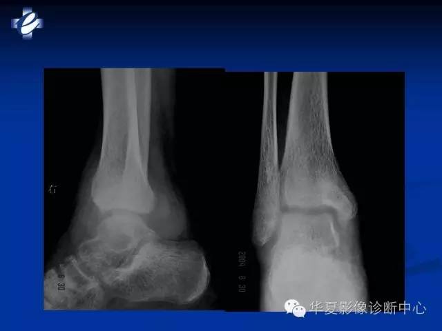 【PPT】骨与关节感染的影像学诊断