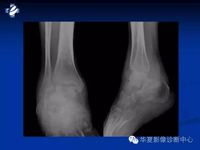 【PPT】骨与关节感染的影像学诊断