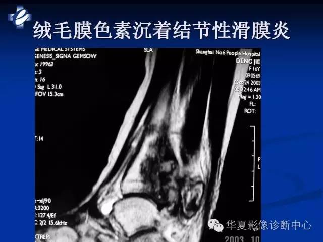 【PPT】骨与关节感染的影像学诊断
