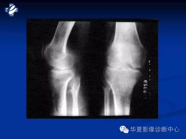 【PPT】骨与关节感染的影像学诊断