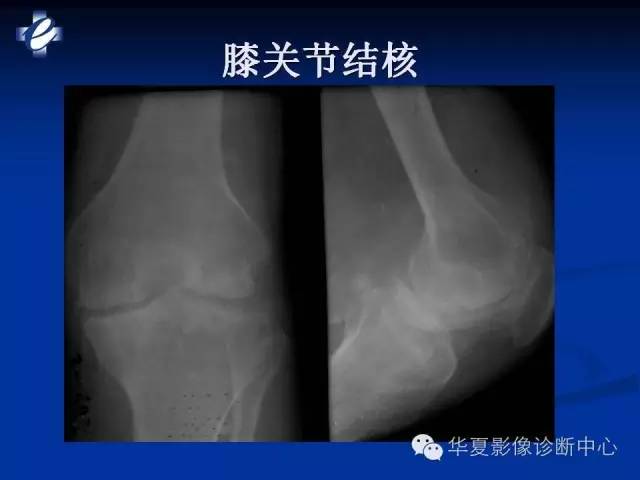 【PPT】骨与关节感染的影像学诊断
