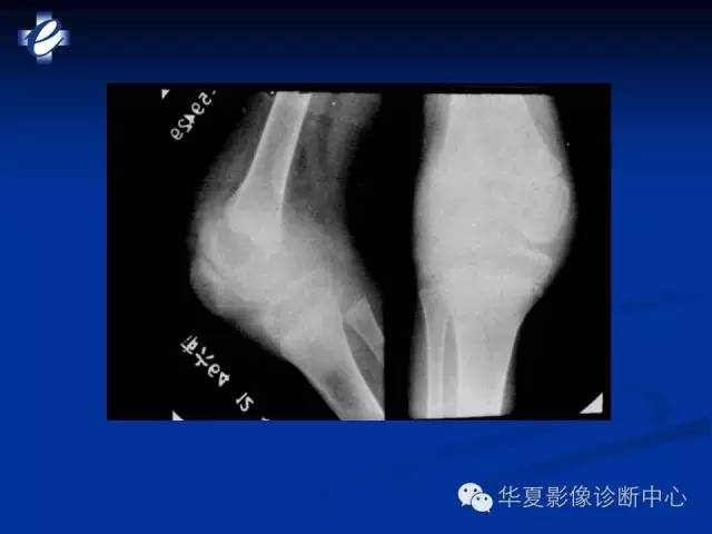 【PPT】骨与关节感染的影像学诊断