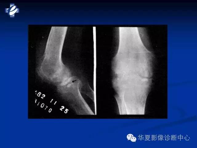 【PPT】骨与关节感染的影像学诊断