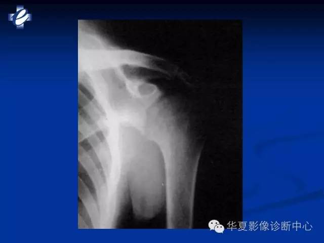 【PPT】骨与关节感染的影像学诊断