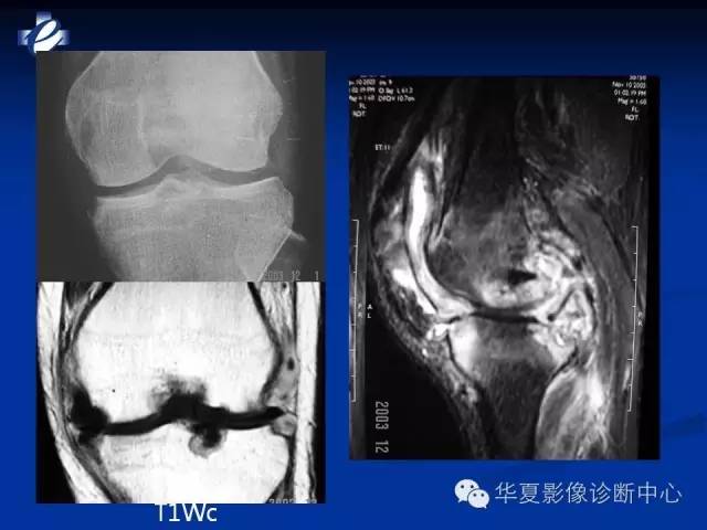 【PPT】骨与关节感染的影像学诊断
