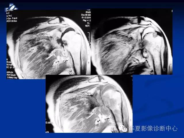 【PPT】骨与关节感染的影像学诊断