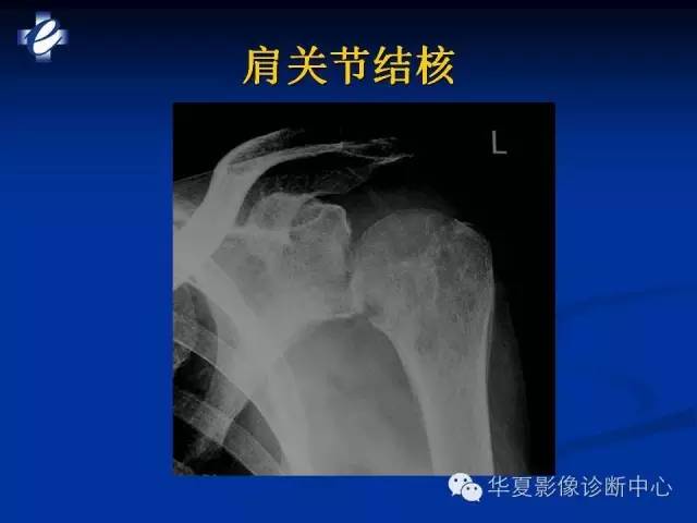 【PPT】骨与关节感染的影像学诊断