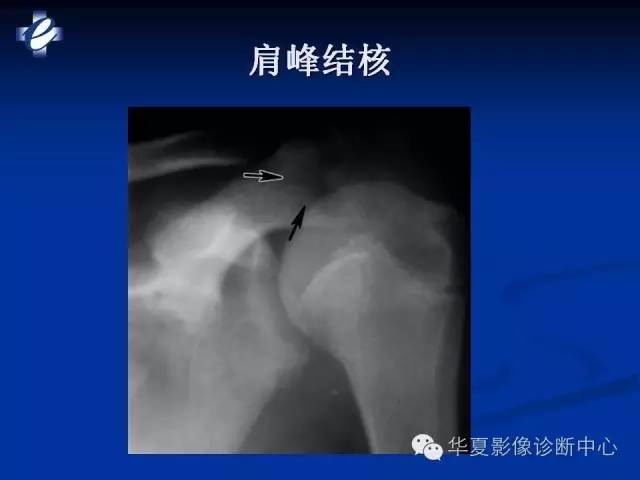 【PPT】骨与关节感染的影像学诊断
