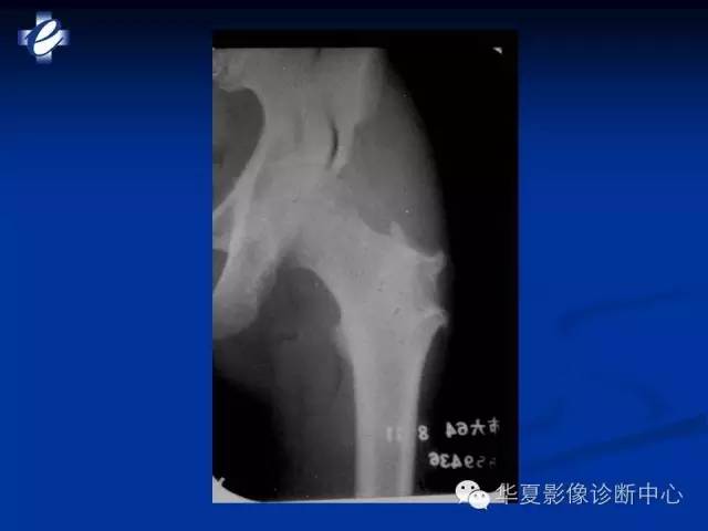 【PPT】骨与关节感染的影像学诊断