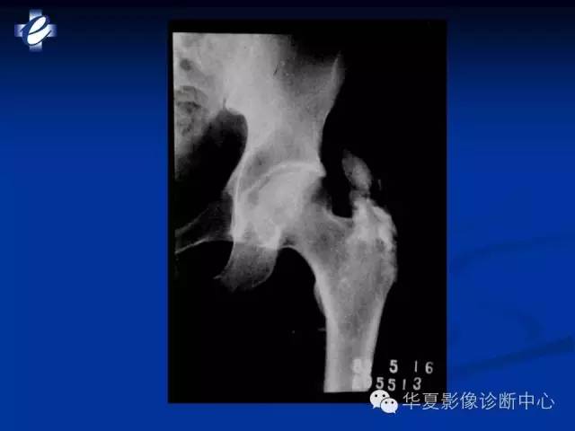 【PPT】骨与关节感染的影像学诊断