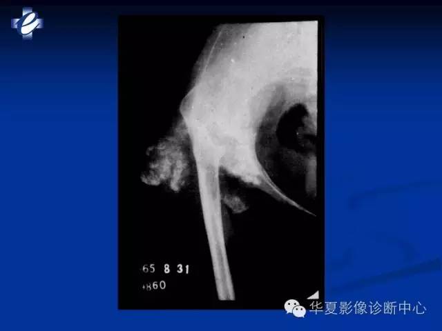 【PPT】骨与关节感染的影像学诊断