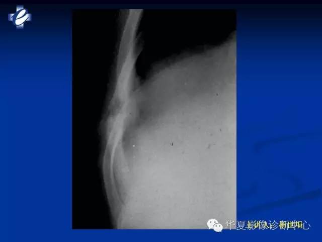 【PPT】骨与关节感染的影像学诊断