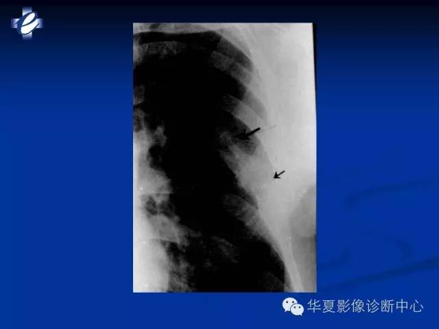 【PPT】骨与关节感染的影像学诊断