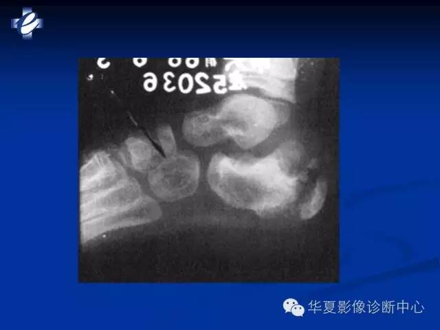 【PPT】骨与关节感染的影像学诊断
