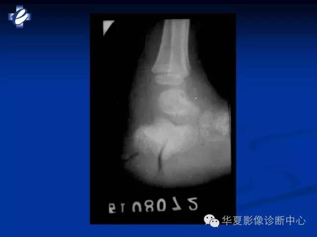 【PPT】骨与关节感染的影像学诊断
