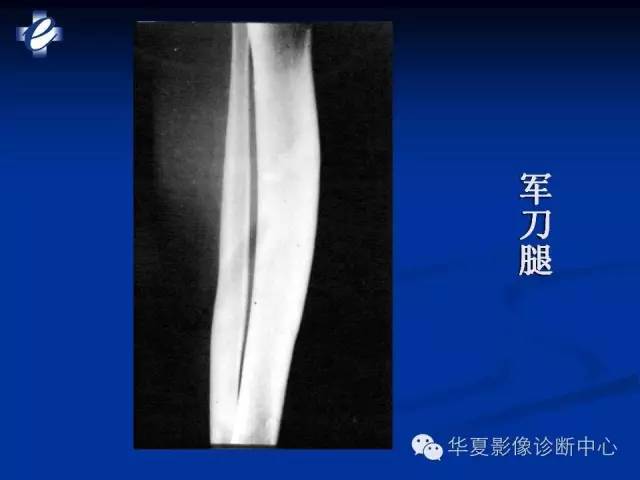 【PPT】骨与关节感染的影像学诊断