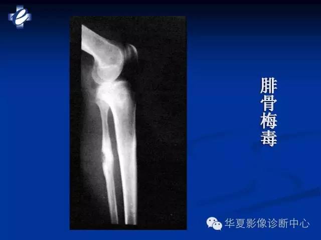 【PPT】骨与关节感染的影像学诊断