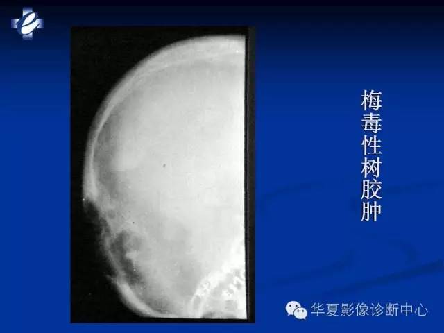 【PPT】骨与关节感染的影像学诊断