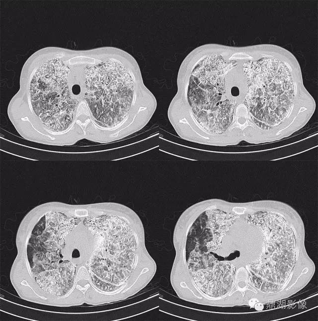 【病例】肺泡微石症1例CT影像表现 【病例】肺泡微石症1例CT影像表现