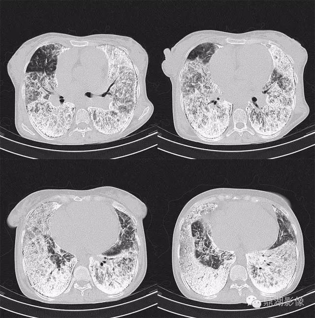 【病例】肺泡微石症1例CT影像表现 【病例】肺泡微石症1例CT影像表现
