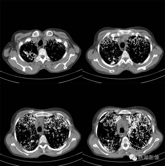 【病例】肺泡微石症1例CT影像表现 【病例】肺泡微石症1例CT影像表现