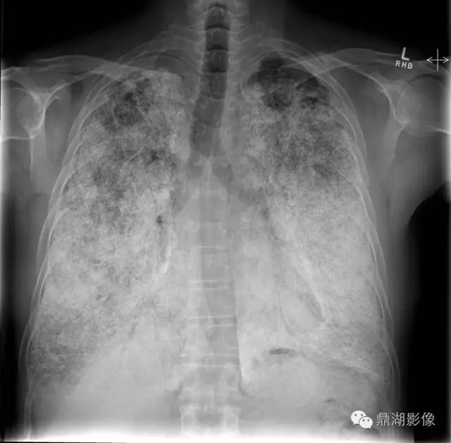 【病例】肺泡微石症1例CT影像表现 【病例】肺泡微石症1例CT影像表现