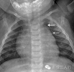 "波浪型胸腺征"，这个征象提示啥？