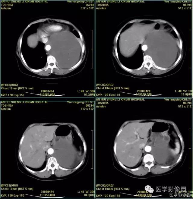 【病例】胸腔孤立性纤维瘤1例CT影像表现