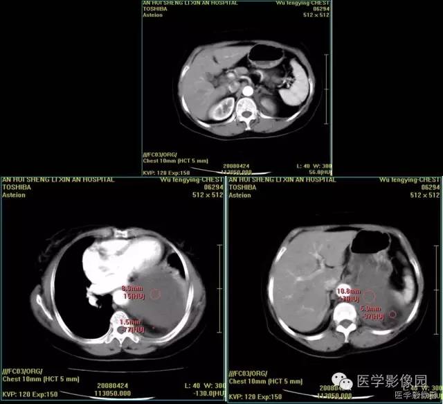 【病例】胸腔孤立性纤维瘤1例CT影像表现