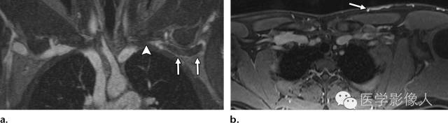 【RG精选】全面解析胸廓出口综合征解剖、临床及影像学表现
